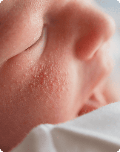 Неонатальное акне