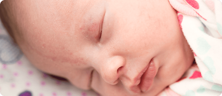 Пятна аиста